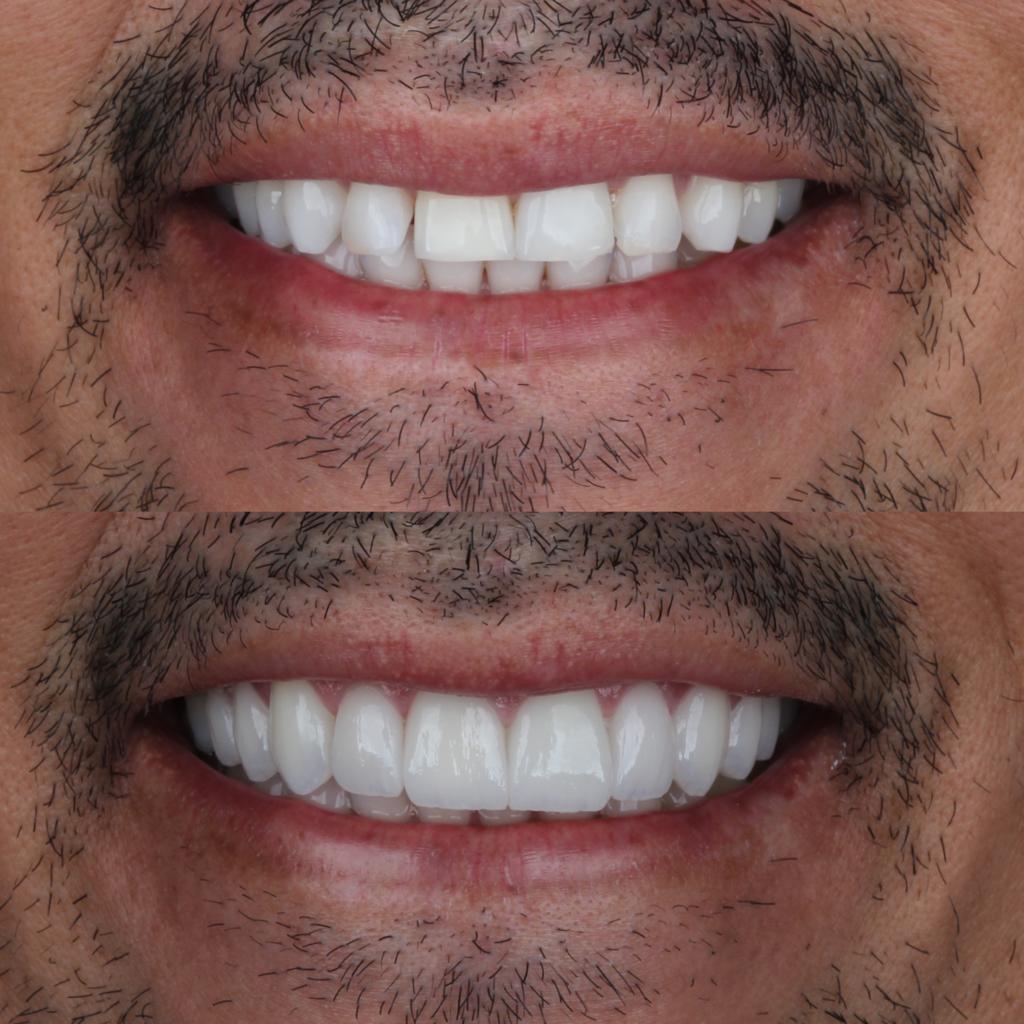 FACETAS PORCELANA MAYKEL